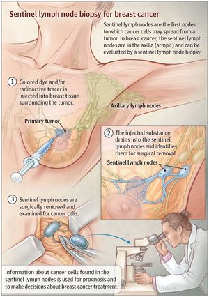 Sentinel lymph node biopsy for breast cancer!