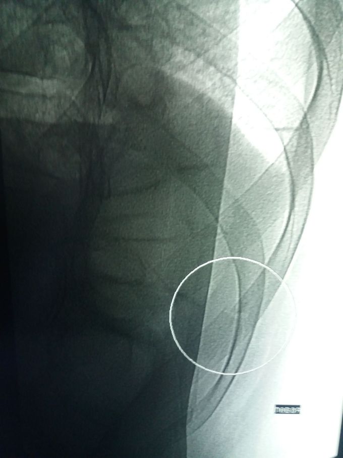 Fracture of rib