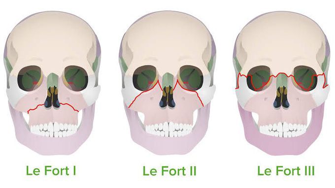 Lefort Classification