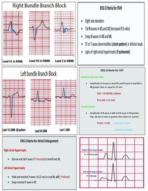 EKG criteria - MEDizzy