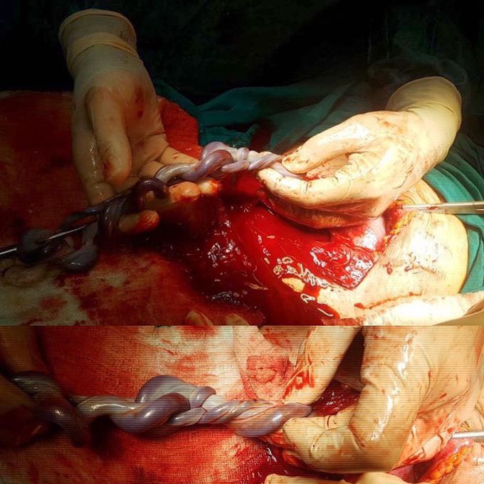 This is an umblical cord knot in twins!! 