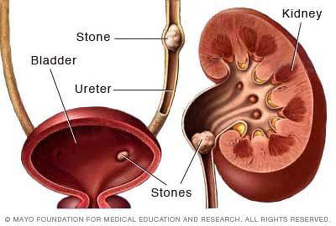 Kidney stones