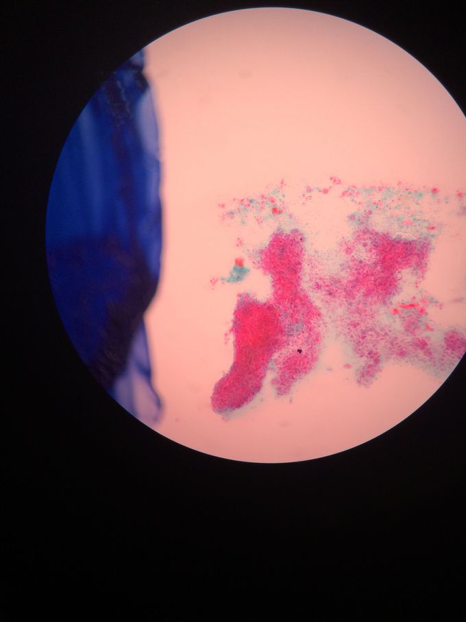 Planocelullar carcinoma