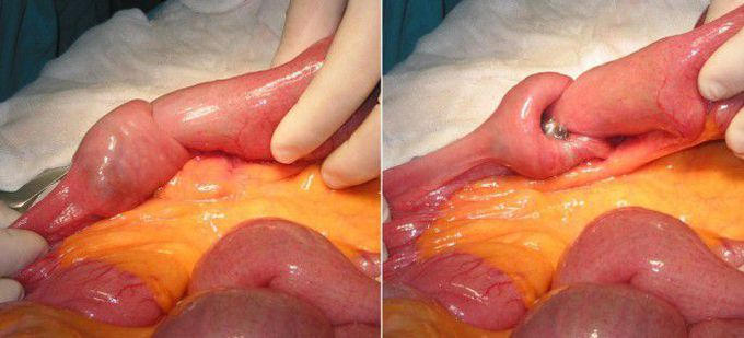 Intussusception: Telescoping of Gut