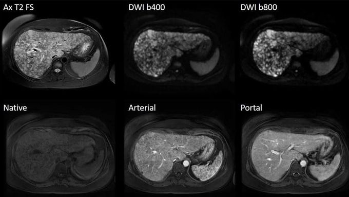 MR Imaging of the liver in a patient with moderate ability of breath-holding