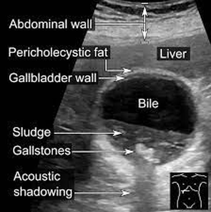 Complications of gall bladder sludge
