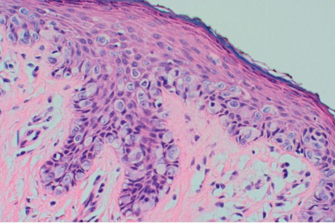 Breast cancer