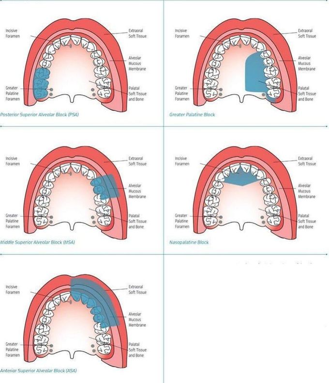 Maxillary Anesthesia - MEDizzy