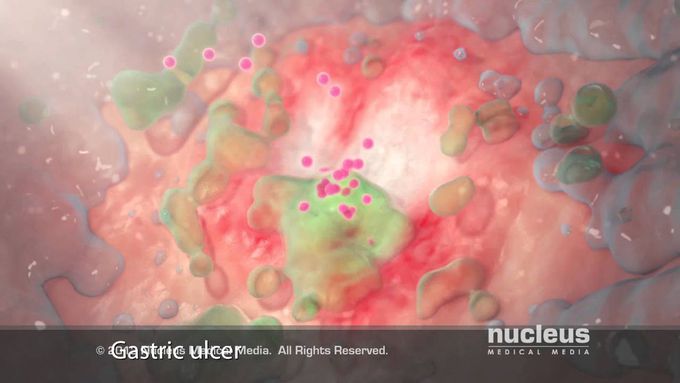 Peptic Ulcer