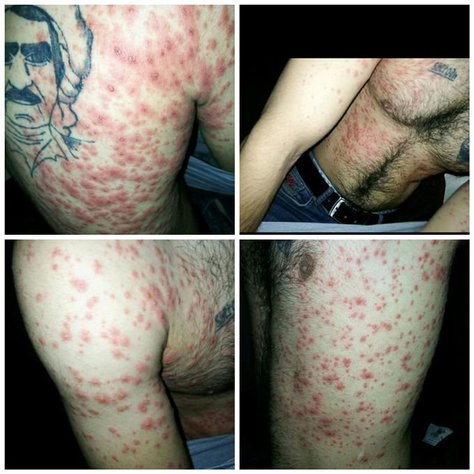 Extensive maculopapular lesions