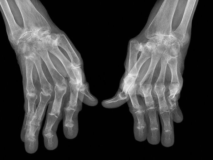 Rheumatoid arthritis