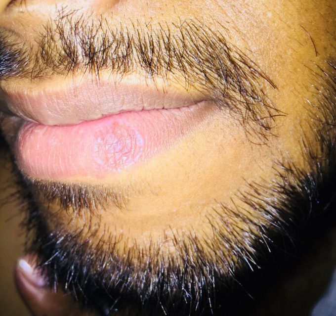 Skin disease 