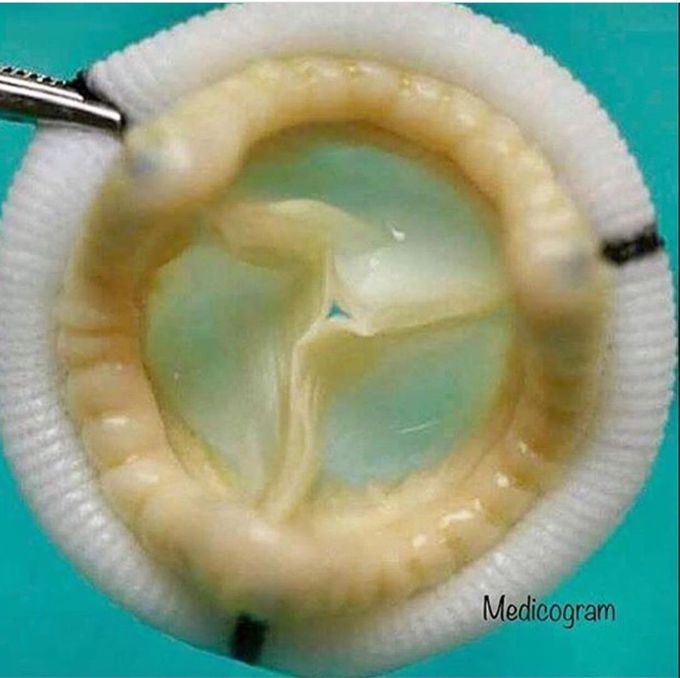 Tricuspid valve..