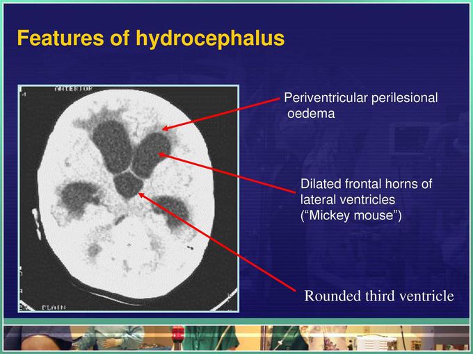 CT Findings of Hydrocephalus