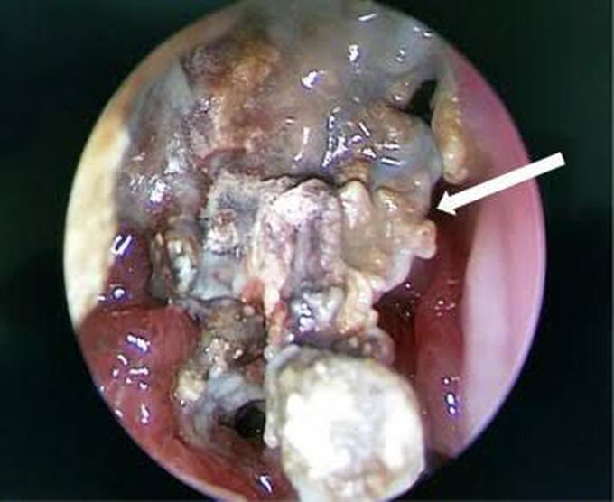 Causes of rhinolith