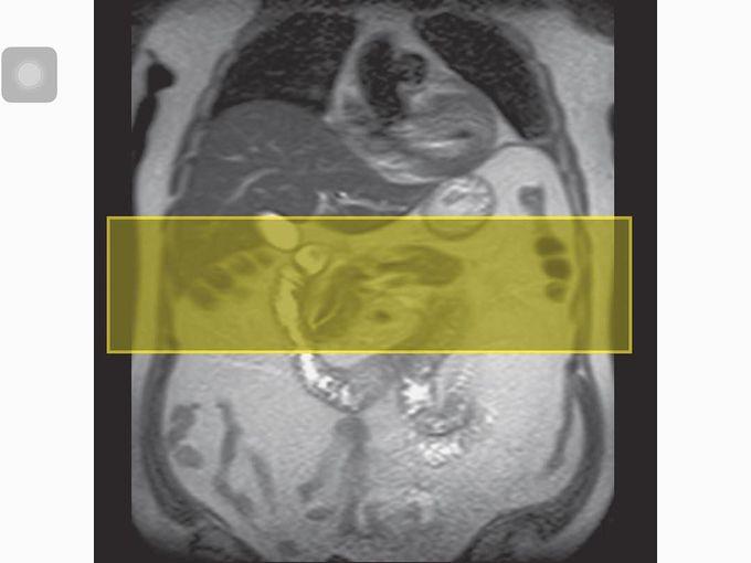 Axial planning for the selective imaging of the pancreas(Westbrook C., 2014)