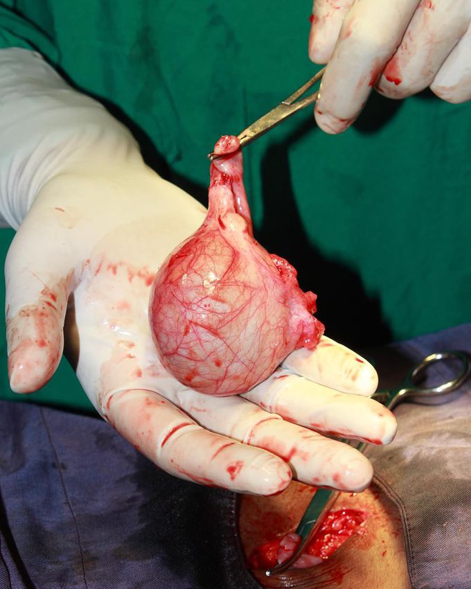 Human heart... just kidding... thats a cyst 
