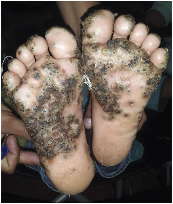 Tungiasis