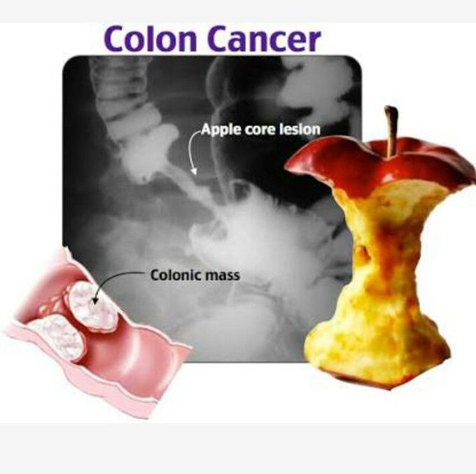 Colon cancer - apple core lesion