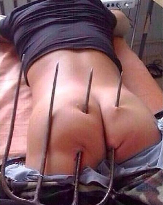 Interesting case of a man being impaled through his gluteal region by a pitchfork!