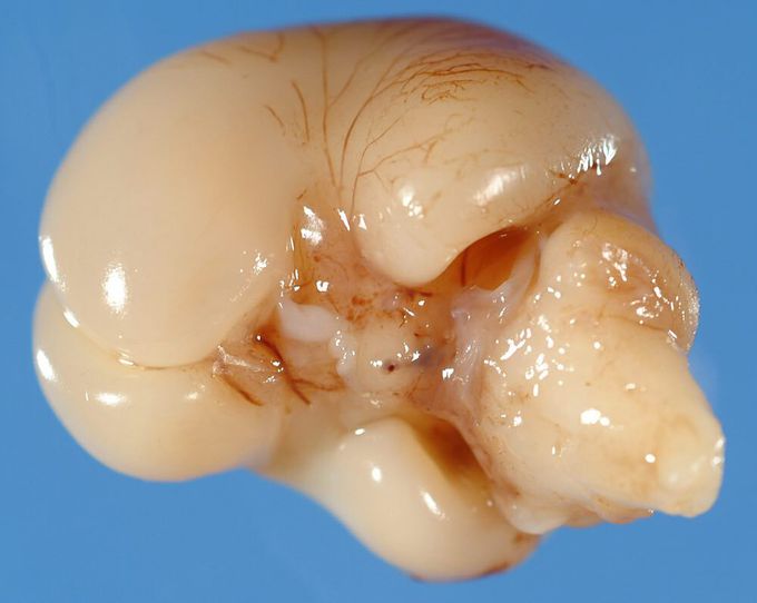 12 weeks fetal brain