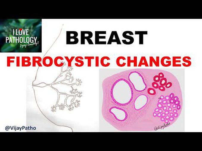 Fibrocystic changes Part 1