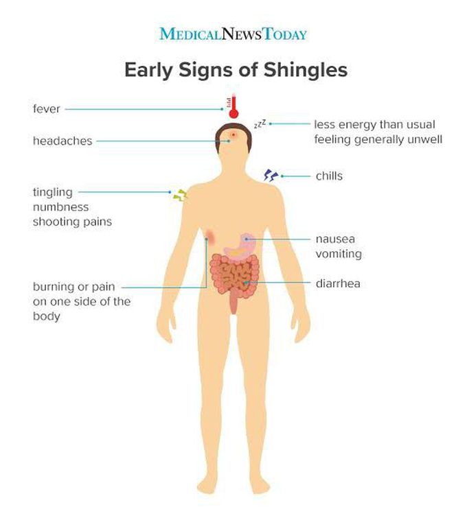 Signs of shingles