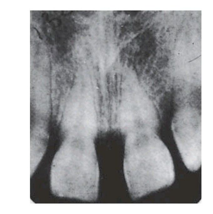 Missing lateral incisors