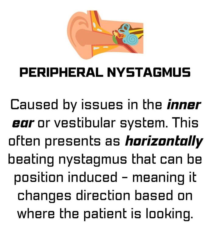 Nystagmus Types II