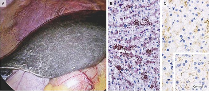 Dubin-Johsnon Syndrome