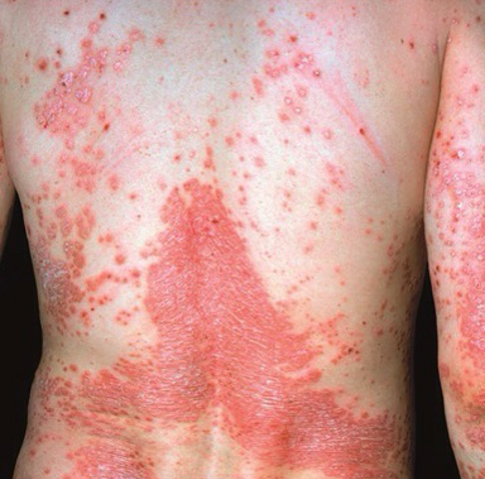 Psoriasis - MEDizzy