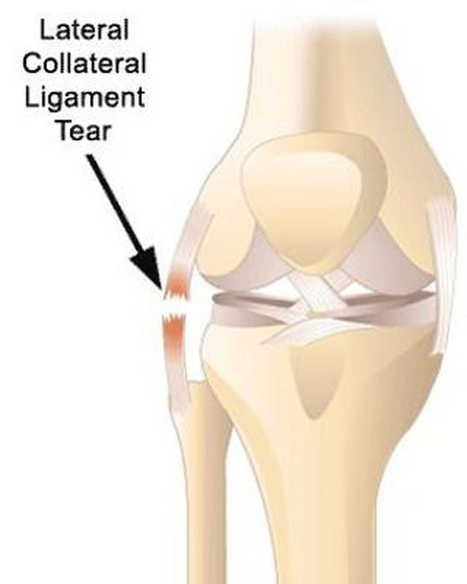 Collateral Ligaments Tear Medizzy 3241