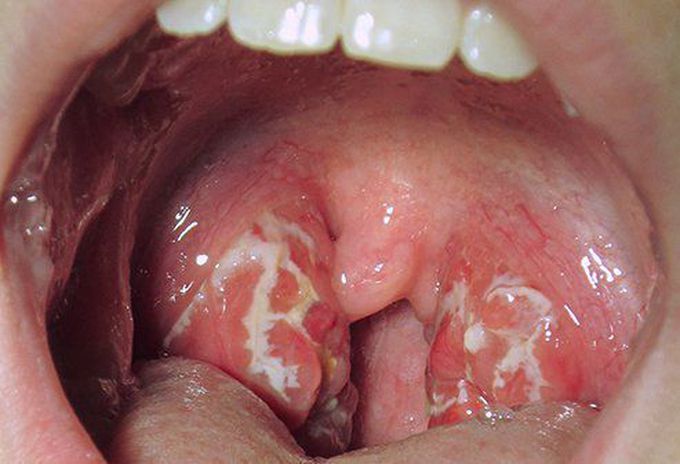 Diagnosis Criteria and Antibiotic of Choice for Acute Rheumatic Fever