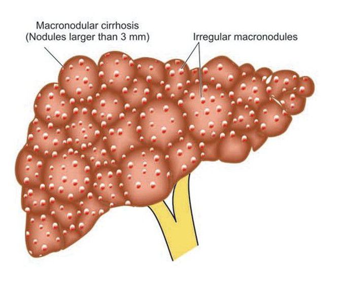 Post-necrotic cirrhosis