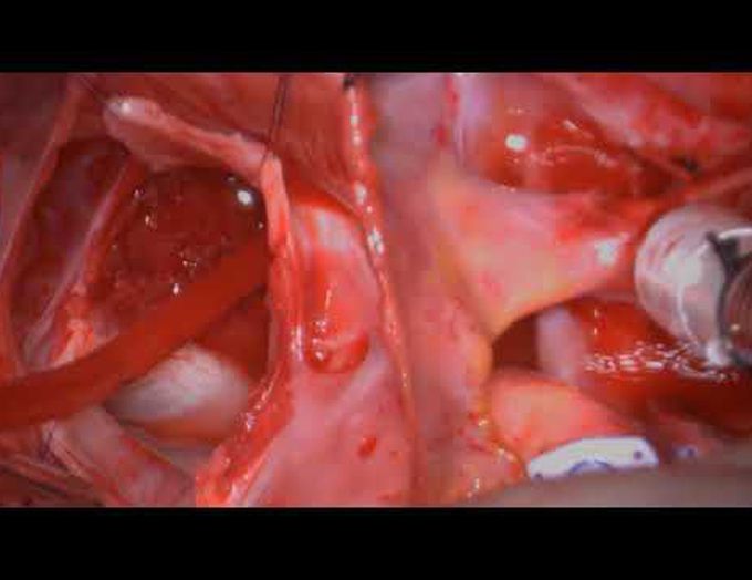 Resection of Left Atrial Leiomyosarcoma in an Adolescent