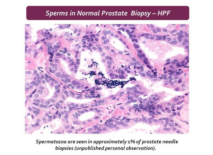 Prostate biopsy