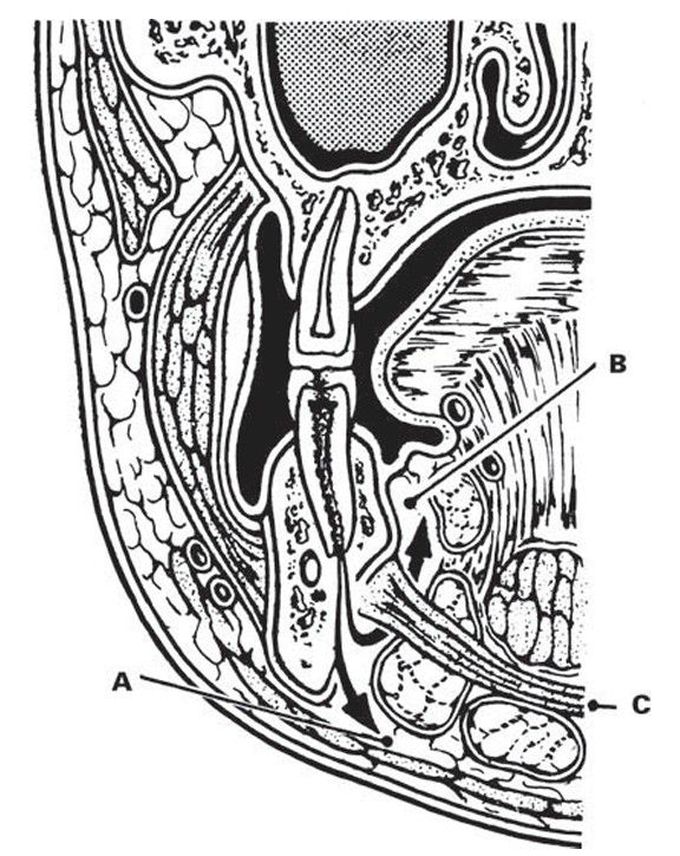 Paths of infection spread from lower molars.