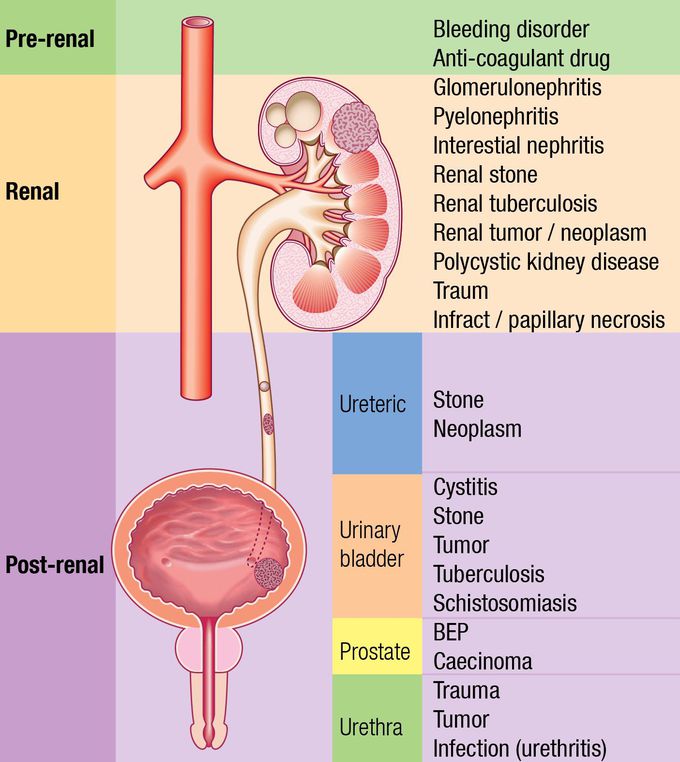 causes of Hematuria