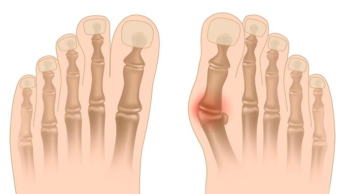 Bunion Surgery