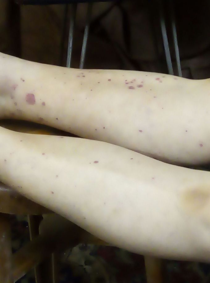 Chronic eruption of red spots