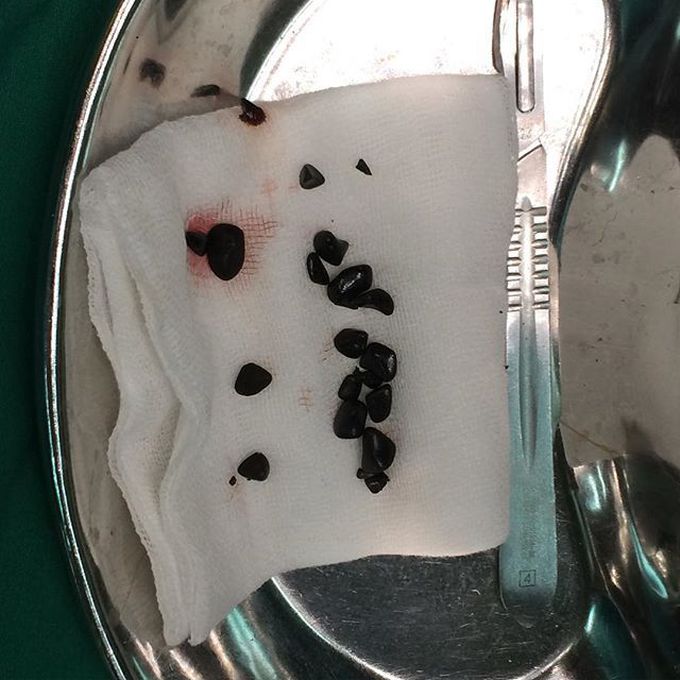 Gallstone