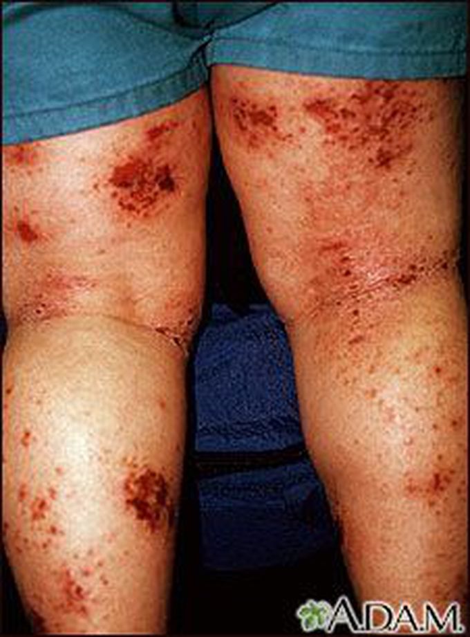 Symptoms of atopic dermatitis