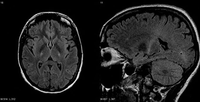 Amyotrophic lateral sclerosis