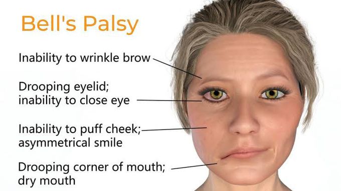 Causes and signs of bell's palsy