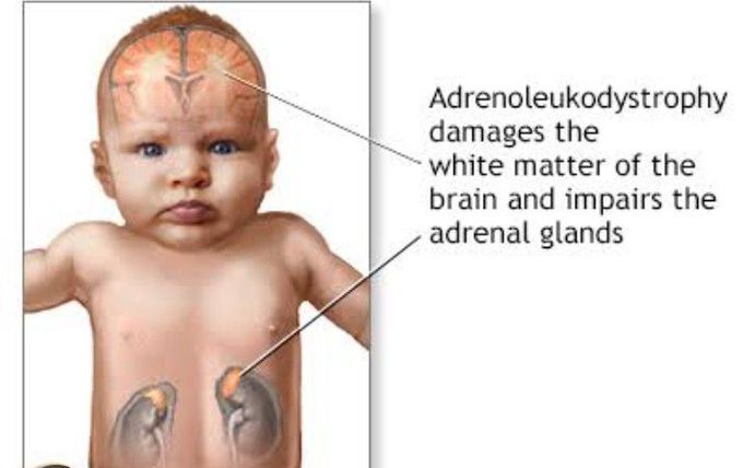 Adrenoleukodystrophy