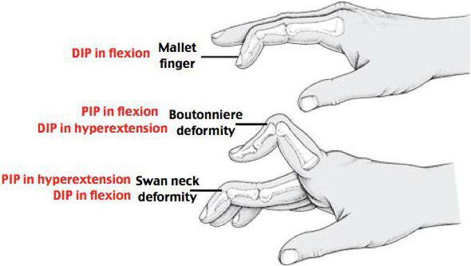 Rheumatoid Arthritis