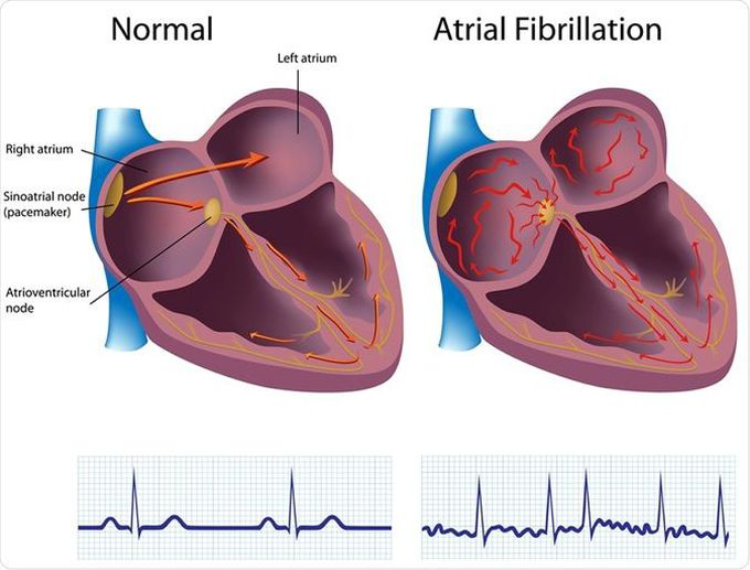 Causes of Atrial Fibrillation - Mnemonic