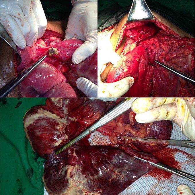 Adult intussusception