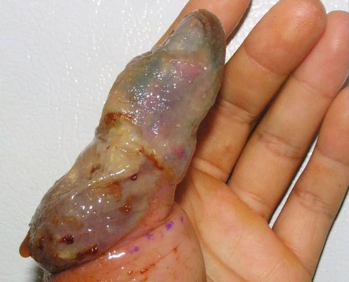 Necrosis of the tissue due to a venomous SNAKE bite! 