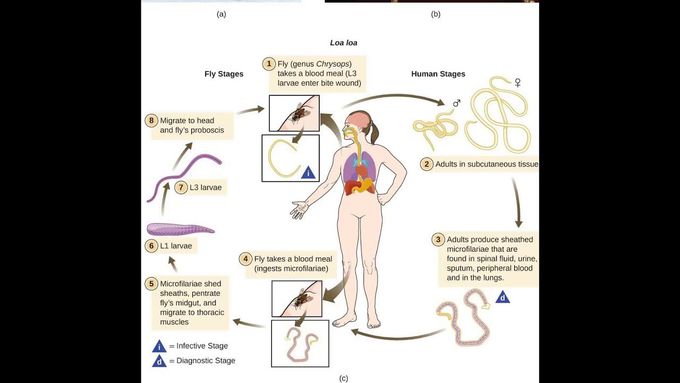 Loiasis- cause, pathology and diagnosis